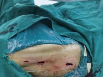 中国最凶险的手术最遭罪手术排名